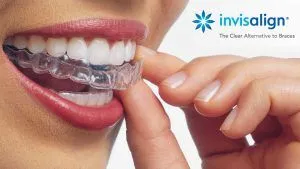 Invisalign at the Perfect Smile Clinic Ltd