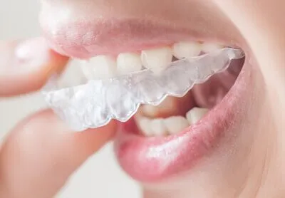 Invisalign