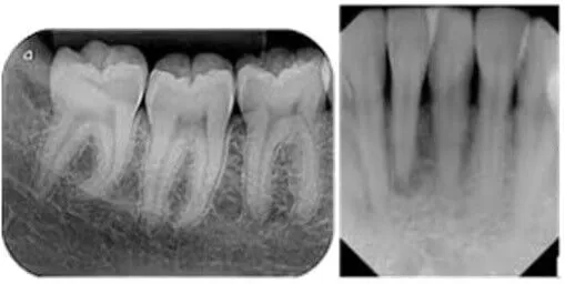 Periapical x-ray example