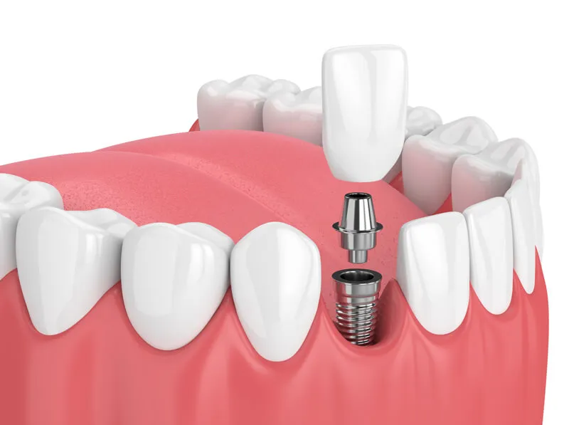 Dental Implants - Perfect Smile Clinic