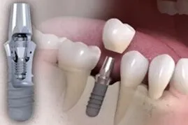 Dental Implants 1