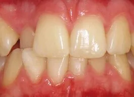 teeth Whitening before