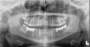 Full mouth x-ray example