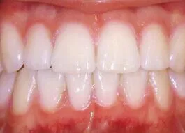 teeth Whitening after