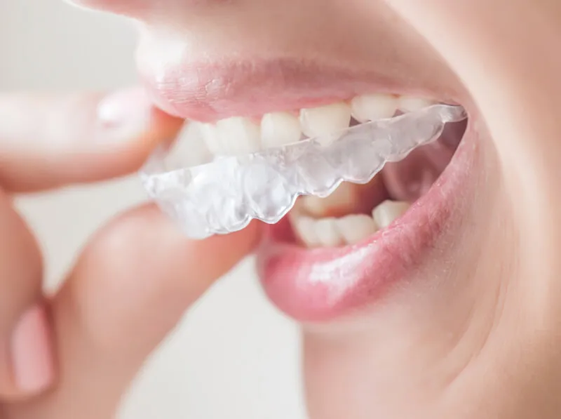 Invisible Braces