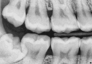 Bitewing x-ray example